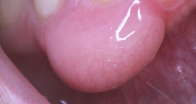 La importancia de la biopsia en la mucinosis focal oral