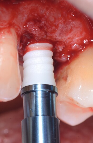 Fig. 7 : Insertion de l’implant.