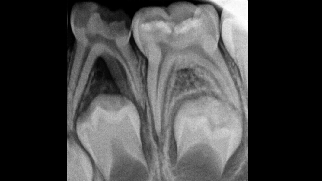 Fig. 6: Four long root canals were detected.