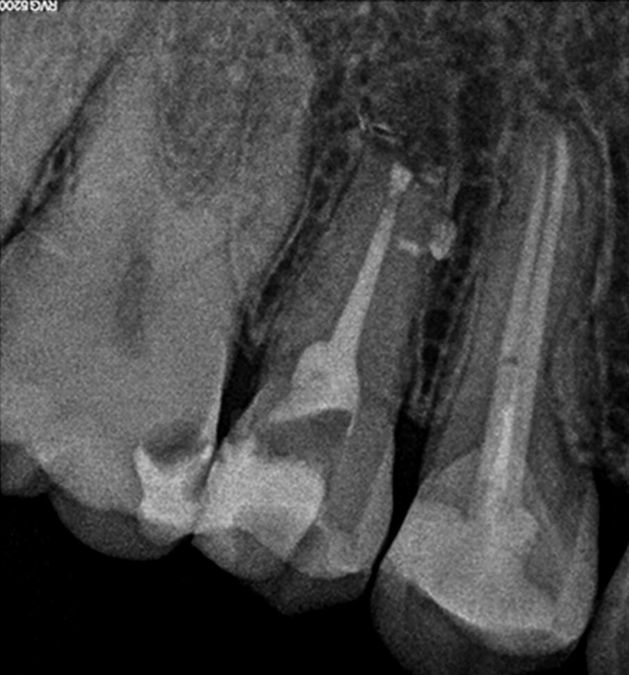 Fig. 2k: Post-op radiograph after apicectomy, retro-preparation and retro-filling with TotalFill BC RRM Fast Set Putty.
