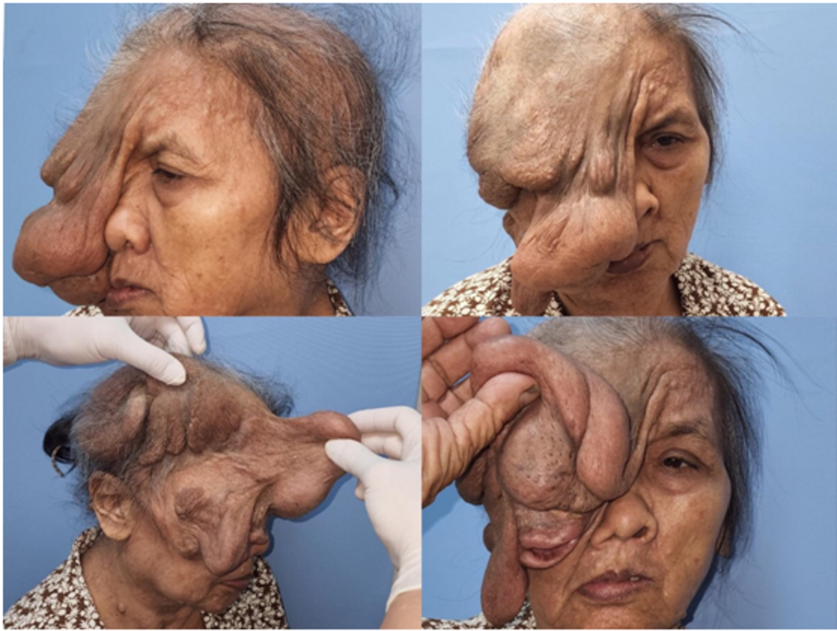 several images of a woman with a large facial tumour