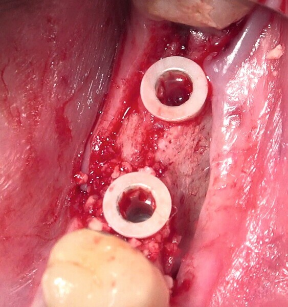 Fig. 28 : Pose de l’un des implants deux pièces en céramique au niveau tissulaire. 