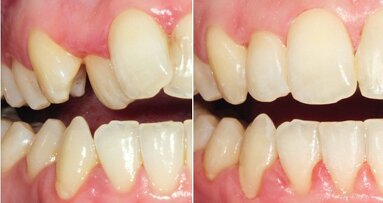 Durchsichtiges Spangensystem: In sechs Monaten zu geraden Zähnen