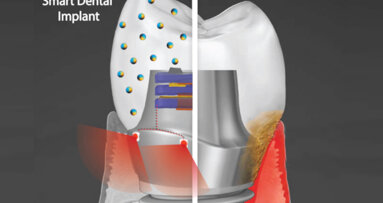 Un implant dentaire intelligent qui utilise la photothérapie pour traiter les gencives infectées