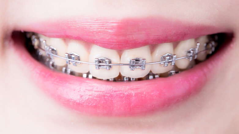 Zusammenhang zwischen Parodontitis und Zahnfehlstellungen