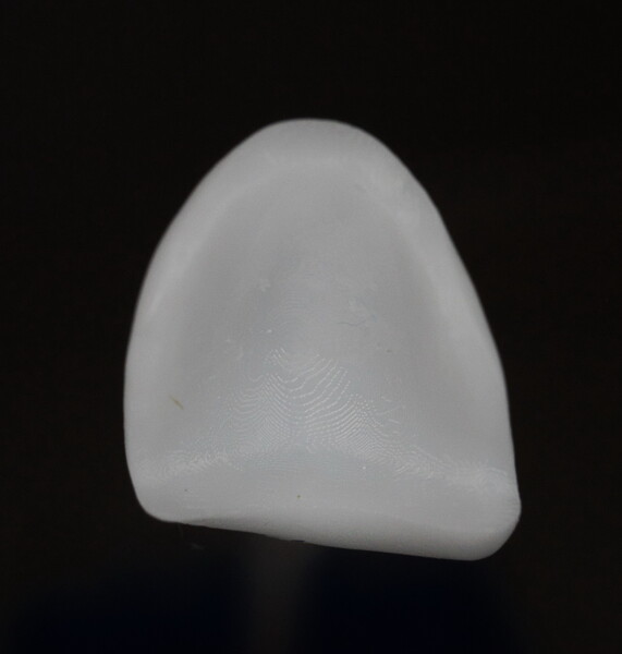 Fig. 13: 3D-printed veneer for tooth #22, lingual view.