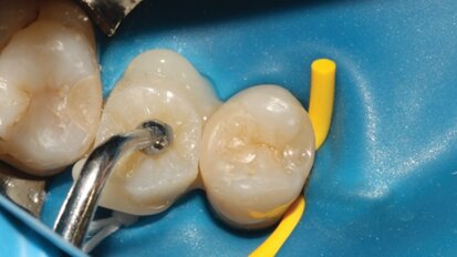 Retraitement endodontique et restauration collée d’une seconde prémolaire structuralement compromise