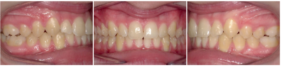 End of mandibular advancement phase (12 months, U: 23 + 26; L: 23 + 26; weekly aligner changes)
