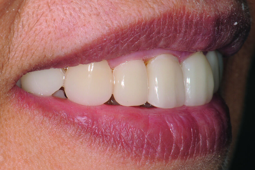 Fig. 23: Try-in: lateral view of smile.