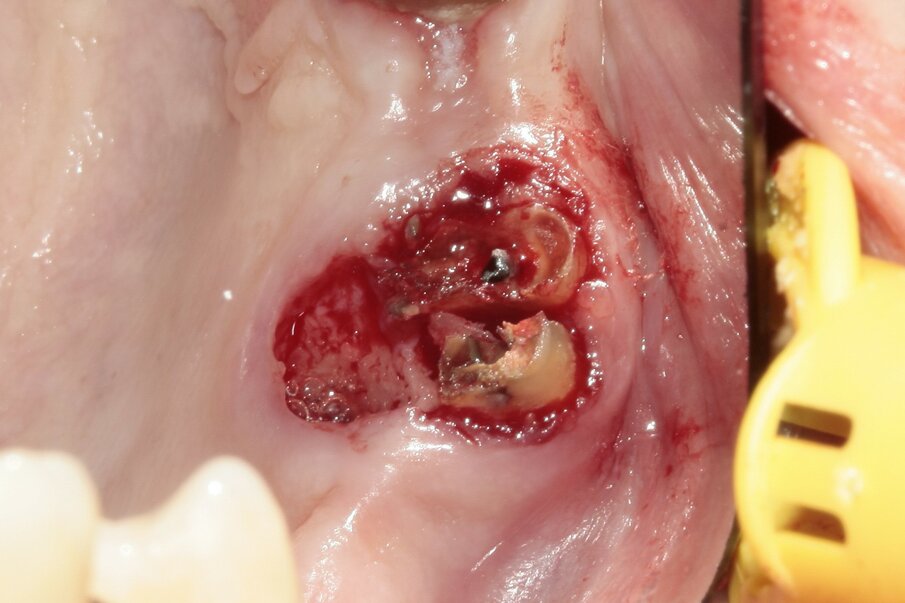 Fig. 7: Palatal root removed. Bone socket after removal of the palatal root.
