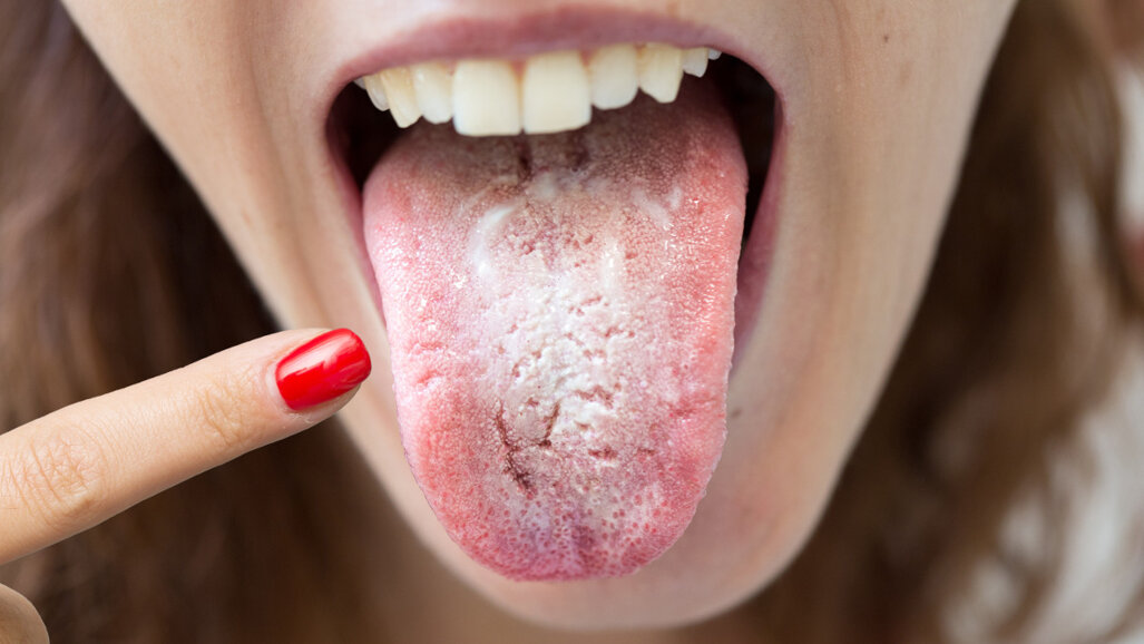 “Língua covid” – O alerta para os sintomas de covid-19 na cavidade oral