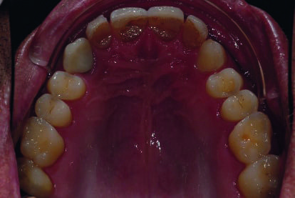 Fig. 2 : Photographie intraorale avant le traitement, vue occlusale du maxillaire. 