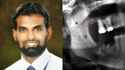 Discovery of 'Coronoid Foramen' by a Bengaluru surgeon Dr Nyer Firdoose could explain pain after LA