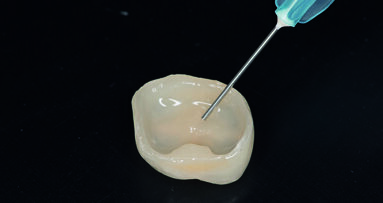 Core Build-Up using Dentsply Sirona’s SDR® Plus