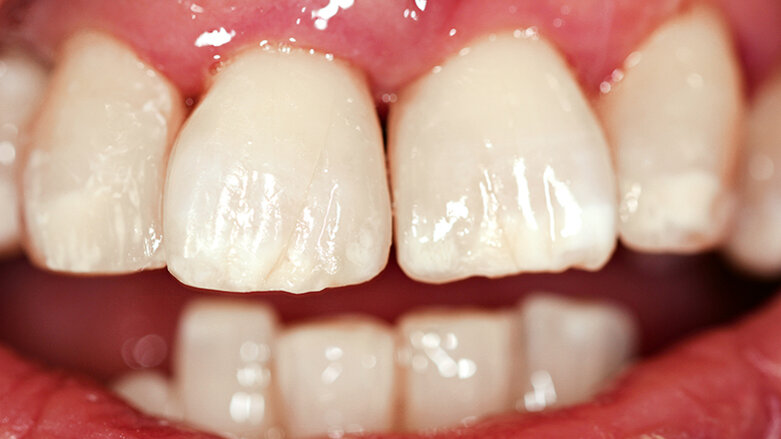 Přímé kompozitní rekonstrukce u pacientů po ortodontické terapii