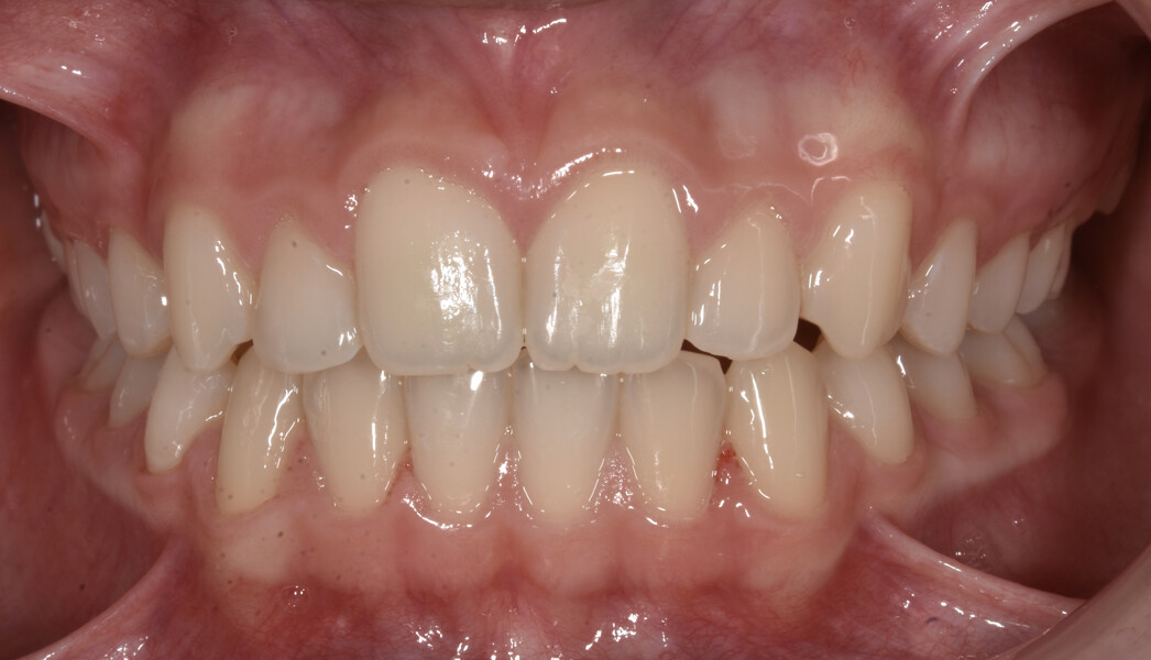 Fig. 4: Facial and intra-oral photographs after treatment with fixed orthodontic appliances.