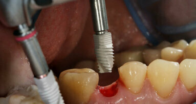 Dlouhodobá studie zkoumá rizikové faktory pro krátké zubní implantáty