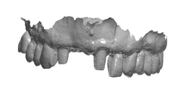 Fig. 2_Scansione intraorale dell’arcata (DEXIS IS 3800w, DEXIS), visione frontale.