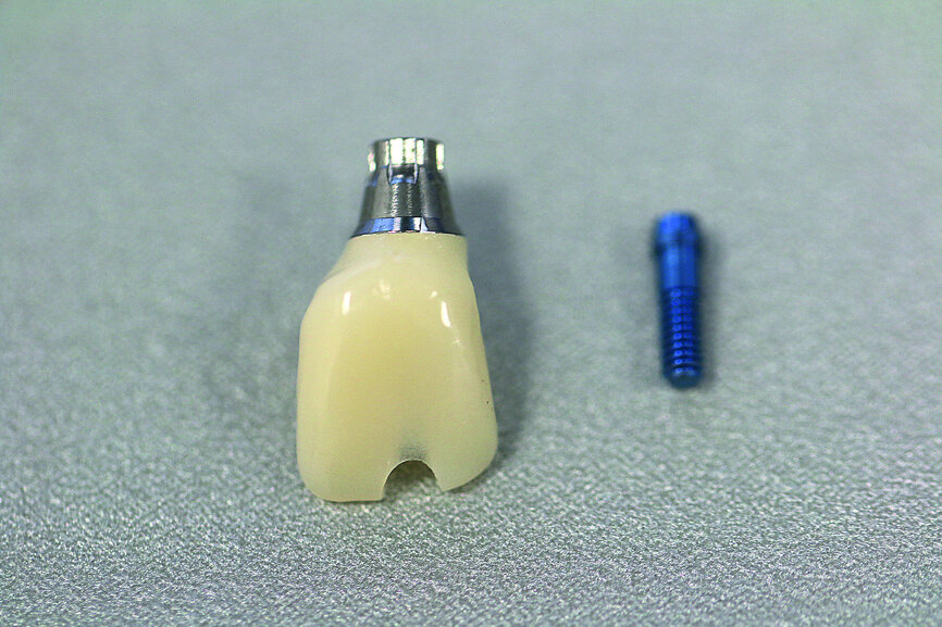 Fig. 12: The screw-retained crown as a finished polished temporary.