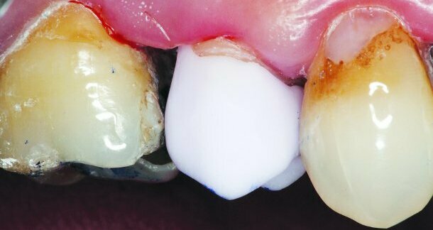 Computer-aided crown design – Fabrication of CAD/CAM crowns chairside