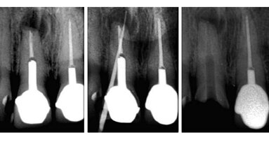 Non-surgical retreatment following failed apicoectomy with re-use of intra-radicular restoration