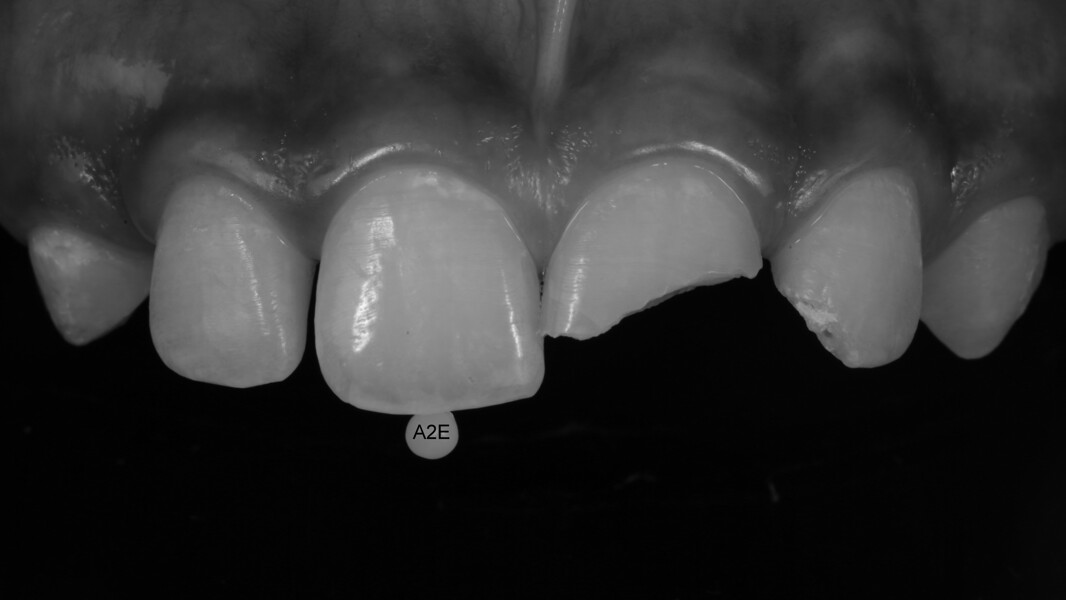 Fig 4: A monochrome picture helps evaluate the Value. A2 Enamel was chosen for this case.