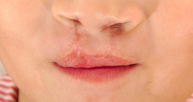 NAM bei Lippen-Kiefer-Gaumenspalte: Nutzen unklar