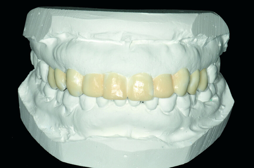 Fig. 13: Wax-up based on pre operation model.