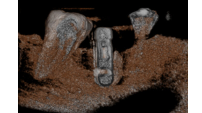 Fig 6. Imagen de reconstrucción del volumen, donde se puede observar falta de densidad ósea en distal y mesial del implante (inicial).