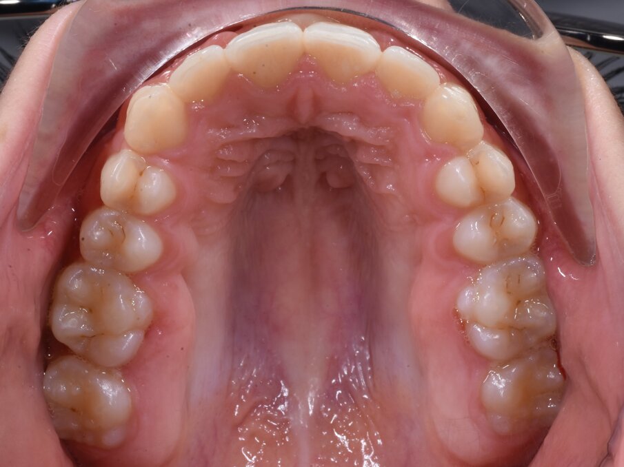 Fig. 5d_Visione occlusale del palato a fine terapia ortodontica.
