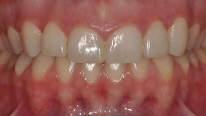 Enhancement of aesthetic treatment planning and communication using a diagnostic mock-up