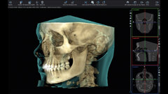 Utilizzo della tomografia computerizzata  a fascio conico (CBCT), dei file STL  e dell’intelligenza artificiale (IA)