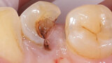 Fig. 1. Situación inicial: el diente 34 estaba fuertemente dañado. La encía se había adentrado en la cavidad.