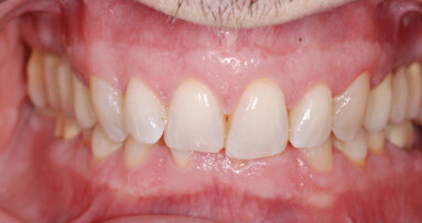 Proper curve of Spee levelling as a key factor in the treatment of deep bite with aligners