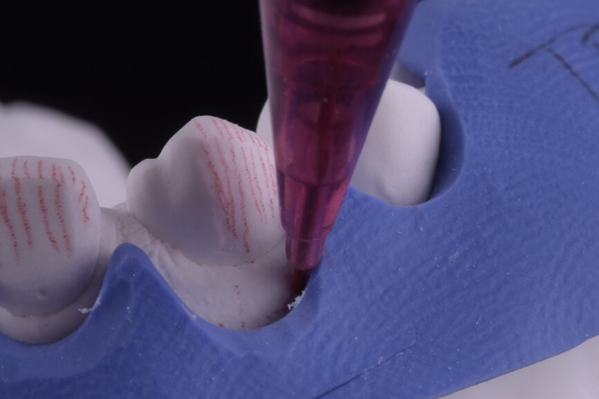 Fig. 44: Surgical silicone index for crown lengthening and cervical contours marked with a red pencil.
