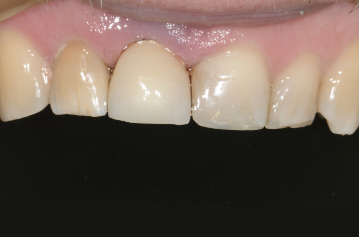 Fig. 16: Sub-crestal placement of the Ankylos implant. Attachment of the screw-retained
IPS e.max crown on to the Atlantis abutment (non-functional restoration).