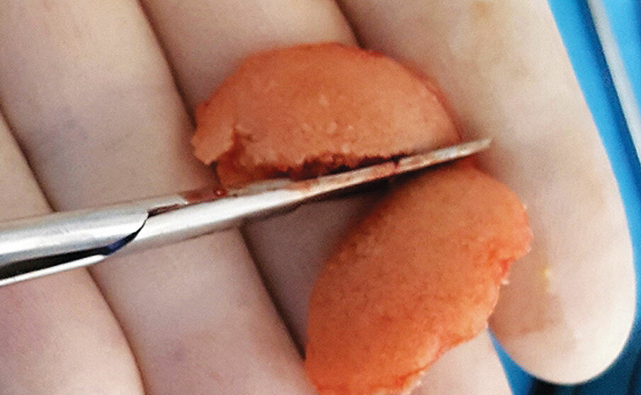 Fig. 17: The ‘gummy bone’ is cut with scissors into smaller pieces that can be incrementally placed into the surgical site.