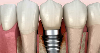 Aspects immunologiques du rejet d’implants dentaire
