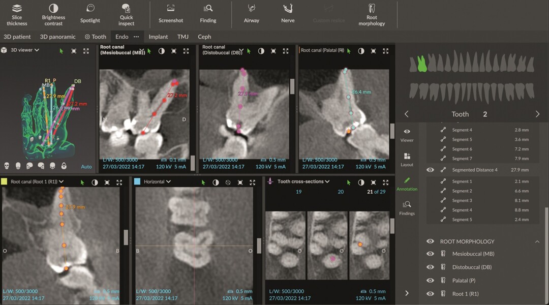 Fig. 3 : Mode endodontique dans DTX Studio Clinic traçant l’anatomie des canaux et indiquant une longueur de travail approximative en différentes couleurs pour chaque canal. Image montrant quatre racines distinctes.