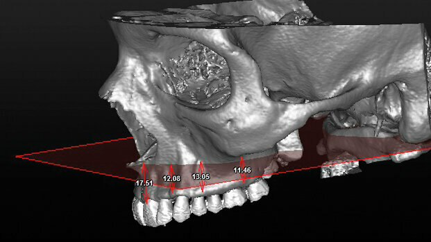 Studio radiologico sulla variazione anatomica delle altezze dei mascellari superiori nelle diverse classi scheletriche