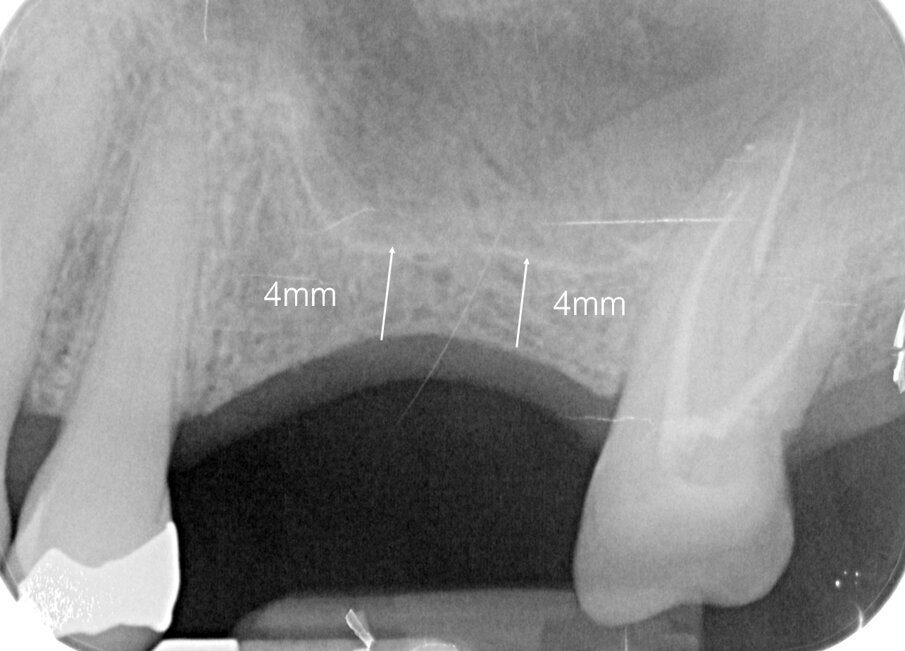 Fig. 2 - Radiografia endorale alla presentazione del paziente. Il paziente è privo degli elementi 2.5 e 2.6; lo spessore crestale è di 4 mm. 