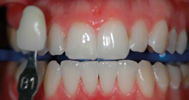 Valutazione clinica degli agenti sbiancanti professionali al 6% e al 25% di perossido di idrogeno su denti vitali