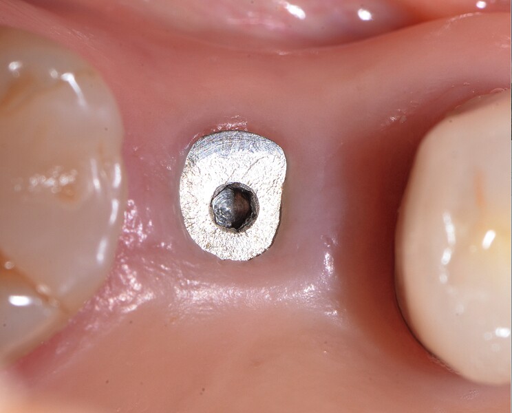 Fig. 45 : Radiographie de contrôle et excellente intégration de l’implant en céramique dans l’environnement parodontal.