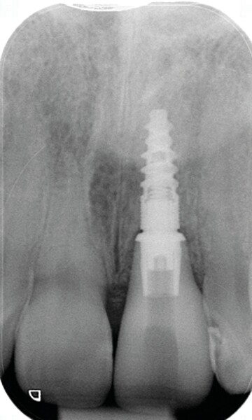 Fig. 22: Radiographie de l’implant et de la couronne in situ à cinq ans.