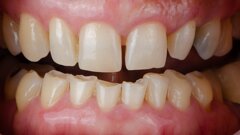 Tooth wear and bruxism: Dentistry’s hidden struggle