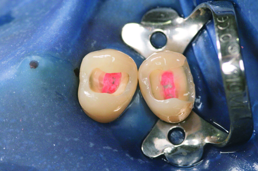 Fig: 2. The root canals were obturated with Gutta-Percha and AH® Plus sealer.