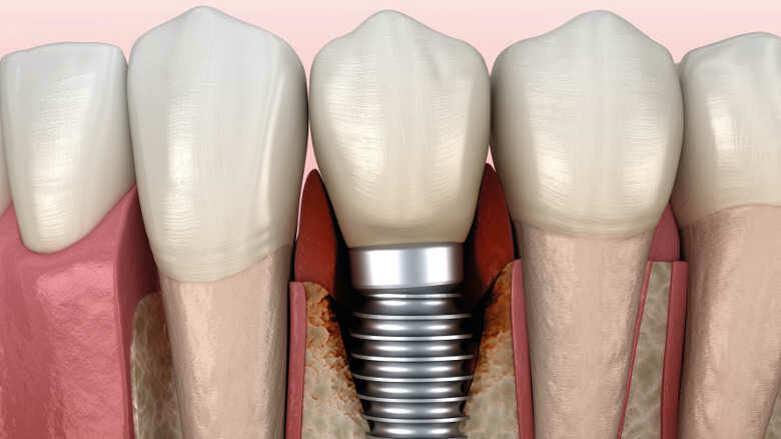 Aspects immunologiques du rejet d’implants dentaire