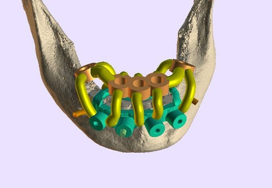 Fig. 8a: Transparent reduced mandible, five implants and yellow abutment projections.