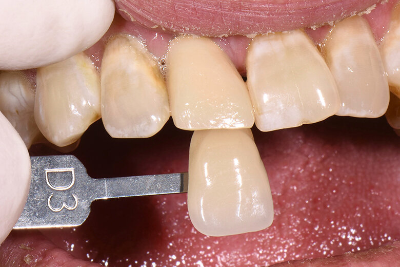 Fig. 2. El color dental básico se determinó mediante la guía de colores VITA classical A1–D3.