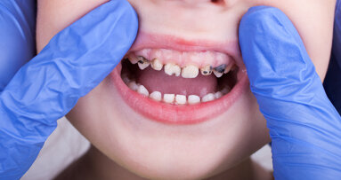 L’EFP rivela l’incredibile costo globale di gengiviti, carie e perdita di denti